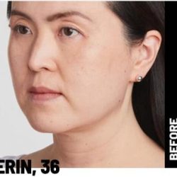 Ultherapy Before & After Patient #1544